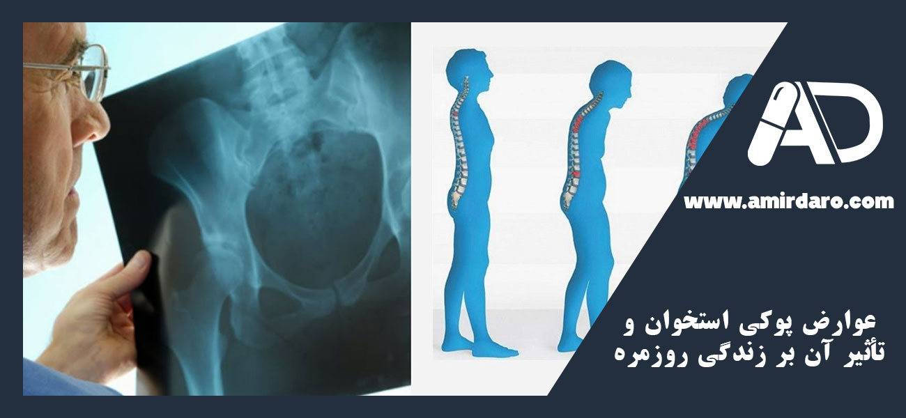 عوارض پوکی استخوان و تأثیر آن بر زندگی روزمره