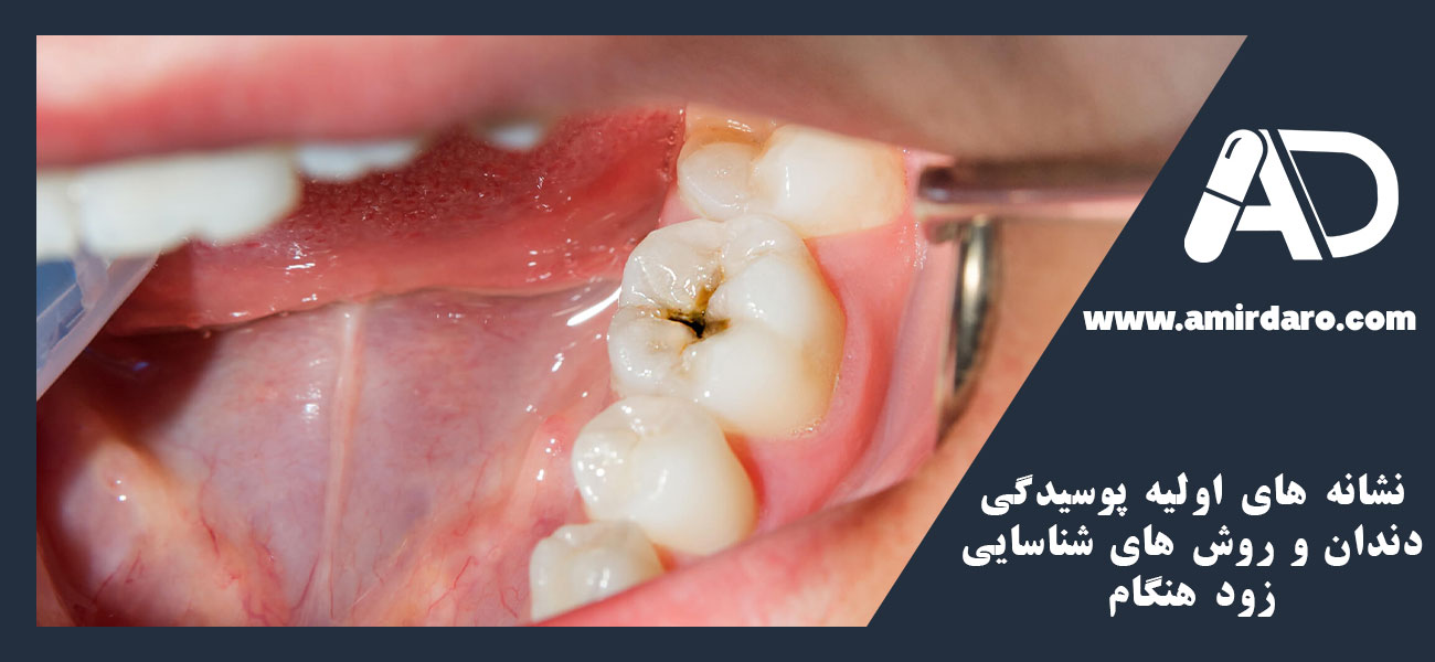 نشانه های اولیه پوسیدگی دندان و روش های شناسایی زود هنگام