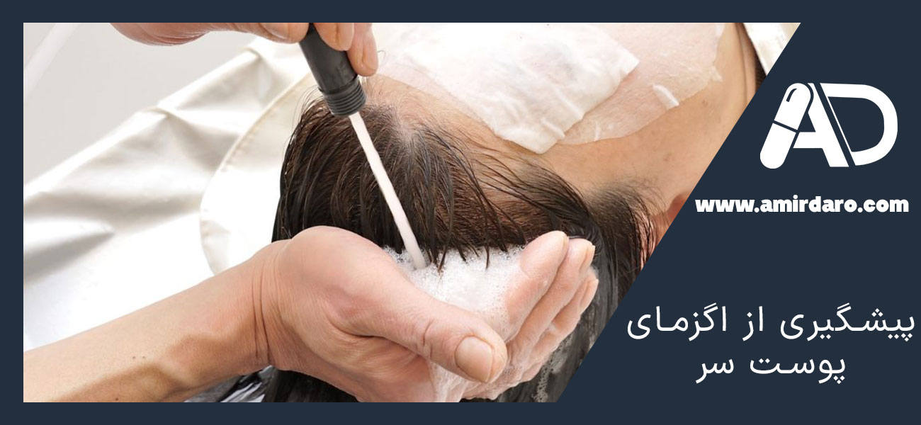 پیشگیری از اگزمای پوست سر