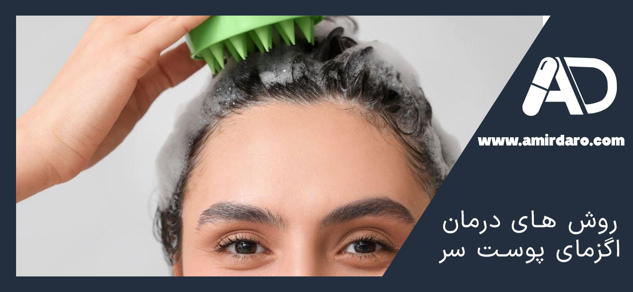 روش های درمان اگزمای پوست سر