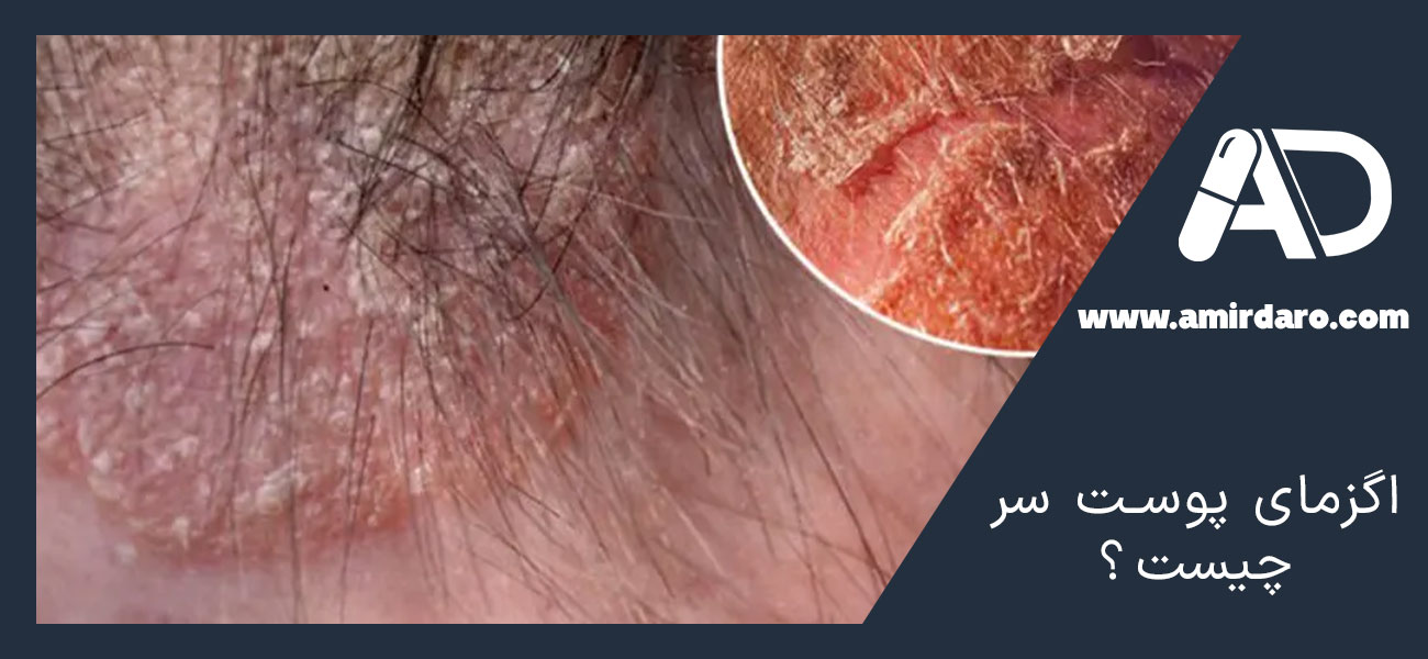 اگزمای پوست سر چیست؟