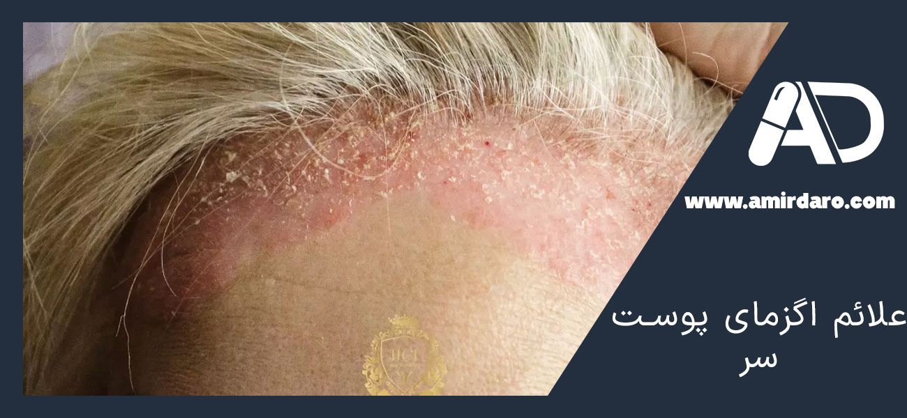 علائم اگزمای پوست سر