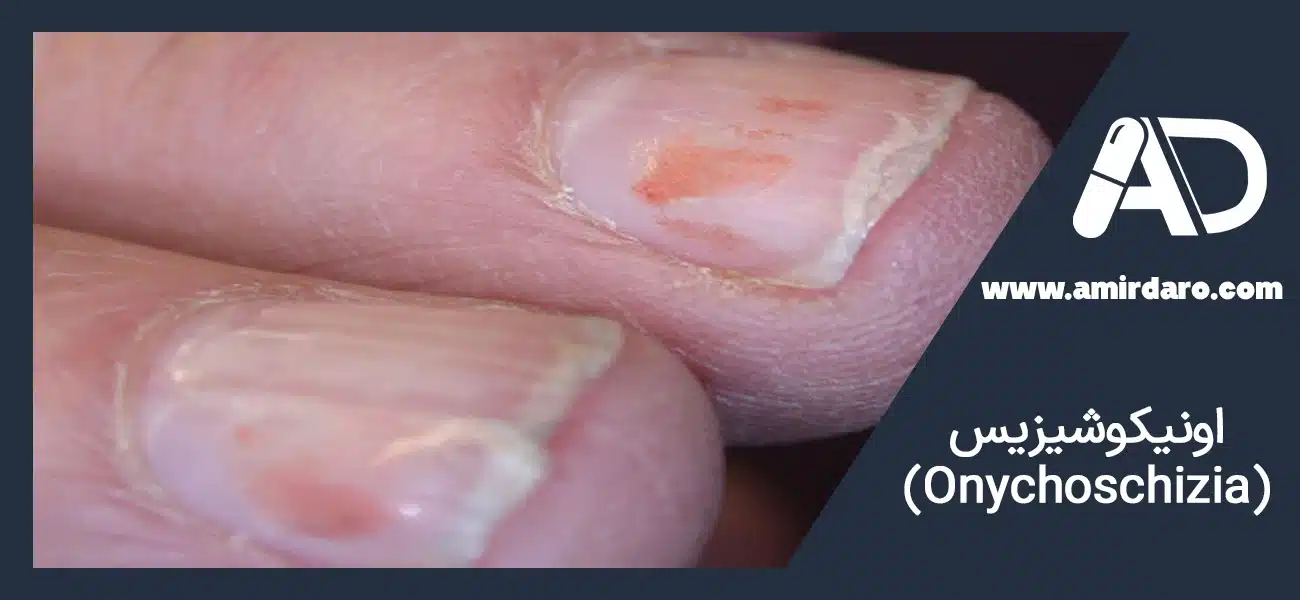 اونیکوشیزیس (Onychoschizia)