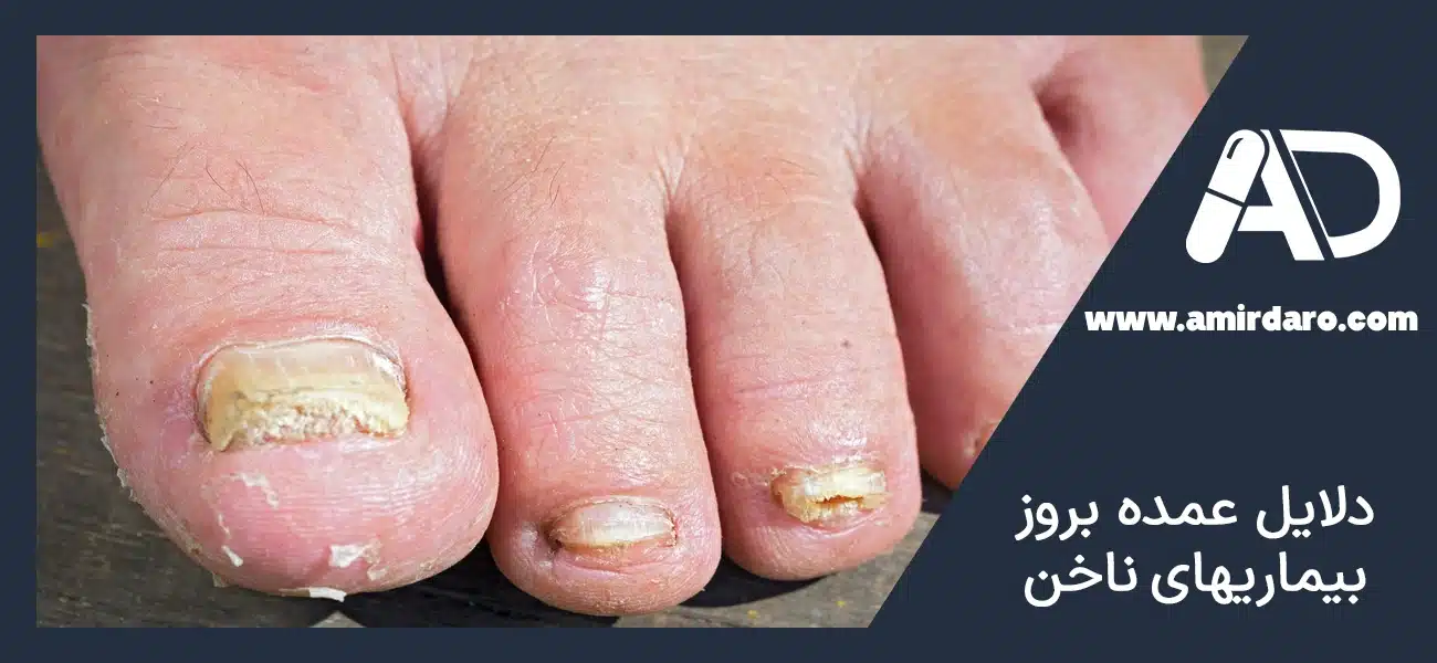 بیماریهای ناخن شست پا؛ مشکلات رایج و خاص