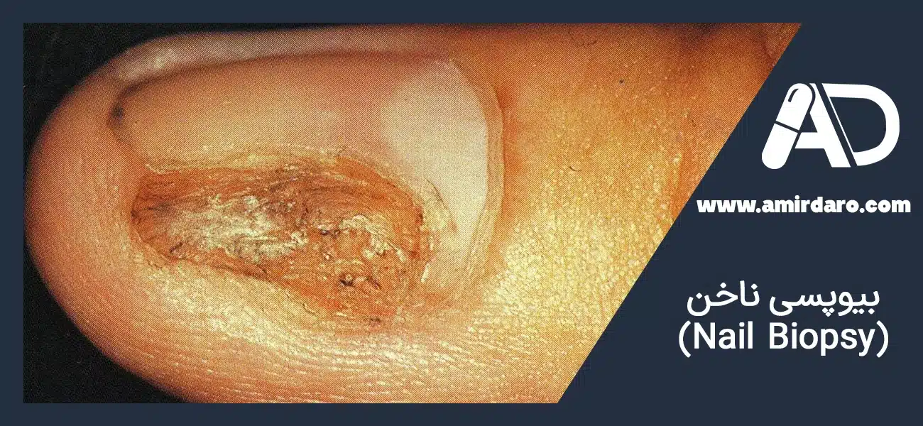 بیوپسی ناخن (Nail Biopsy)