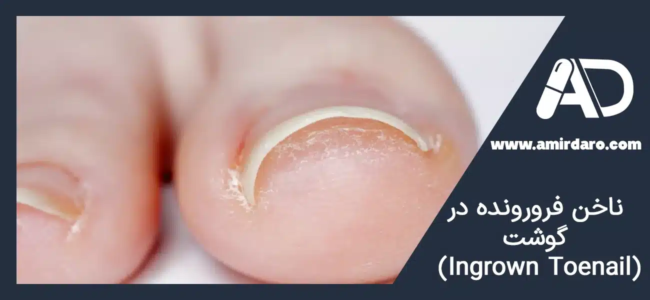 ناخن فرورونده در گوشت (Ingrown Toenail)