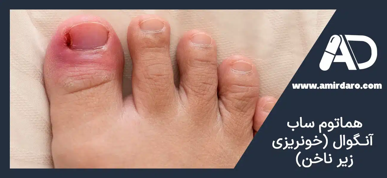 هماتوم ساب‌ آنـگوال (خونریزی زیر ناخن)