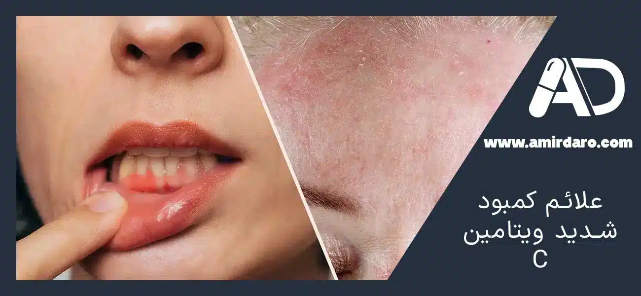 علائم کمبود شدید ویتامین C