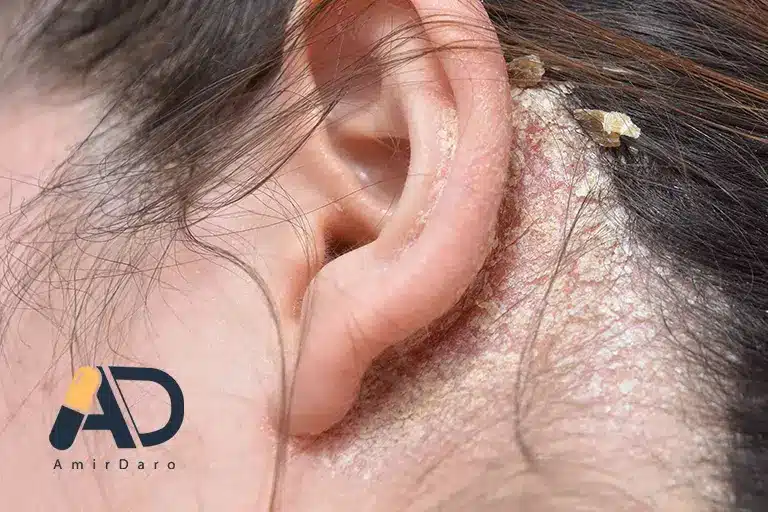 بیماری سبوره چیست؟