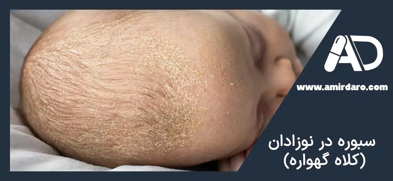 سبوره در نوزادان: کلاه گهواره