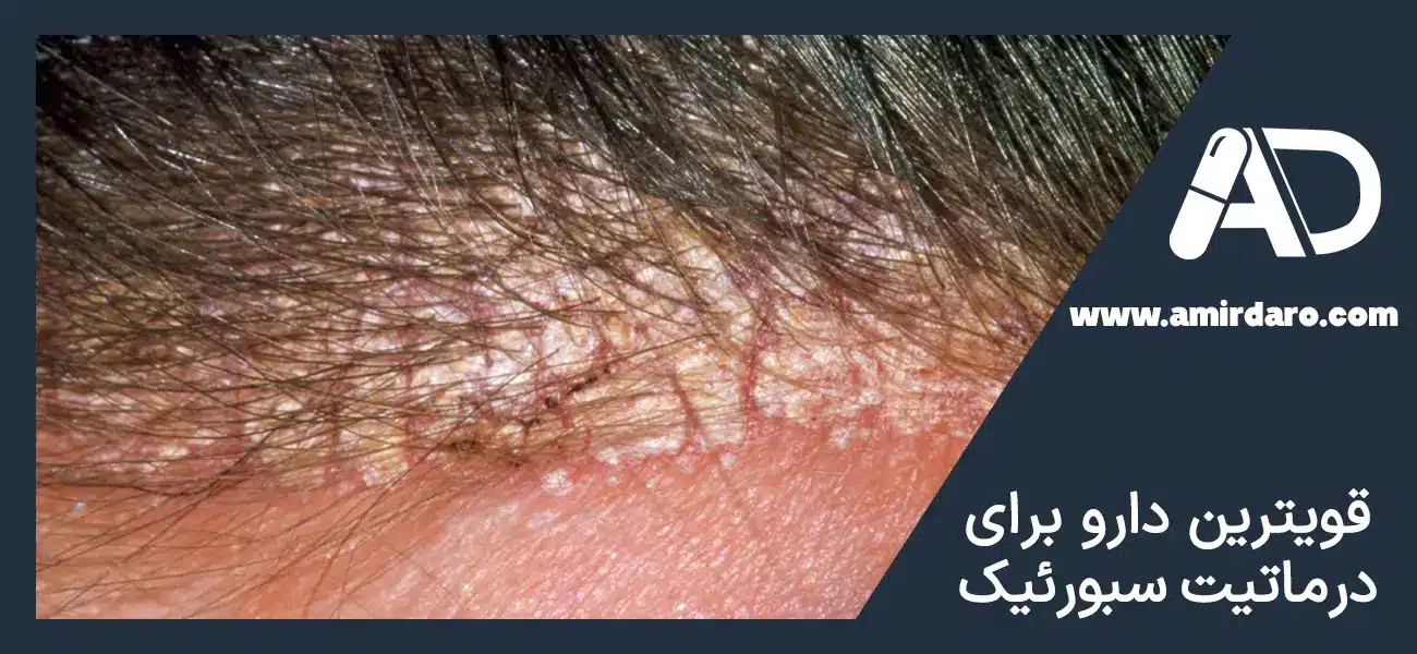 قوی ترین دارو برای درمان درماتیت سبورئیک