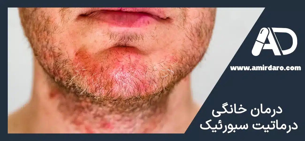 درمان خونگی درماتیت سبورئیک