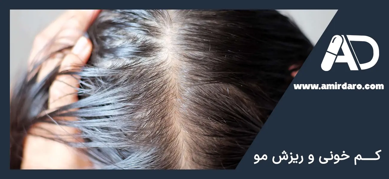 کم خونی ناشی از ریزش مو
