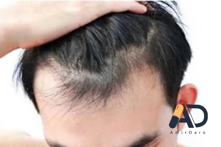 ریزش مو ناشی از استرس