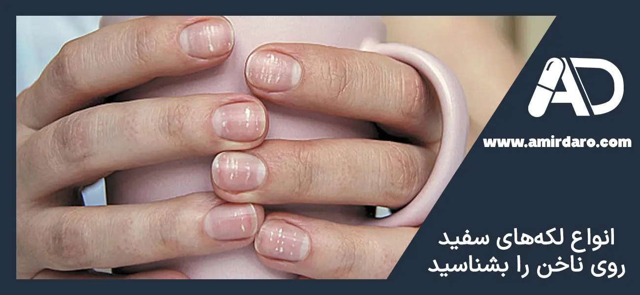 انواع لکه سفید روی ناخن