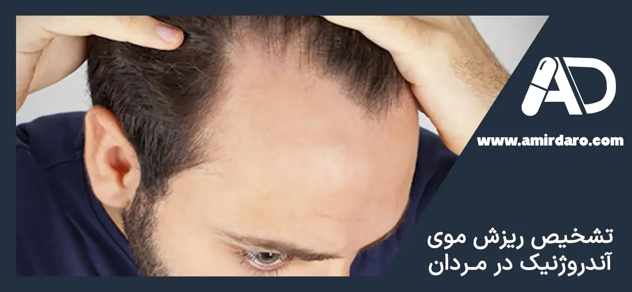 چگونه ریزش موی آندروژنیک در مردان تشخیص داده می‌شود؟